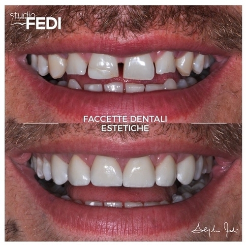Estetica dentale a Firenze  Faccette Dentali Estetiche